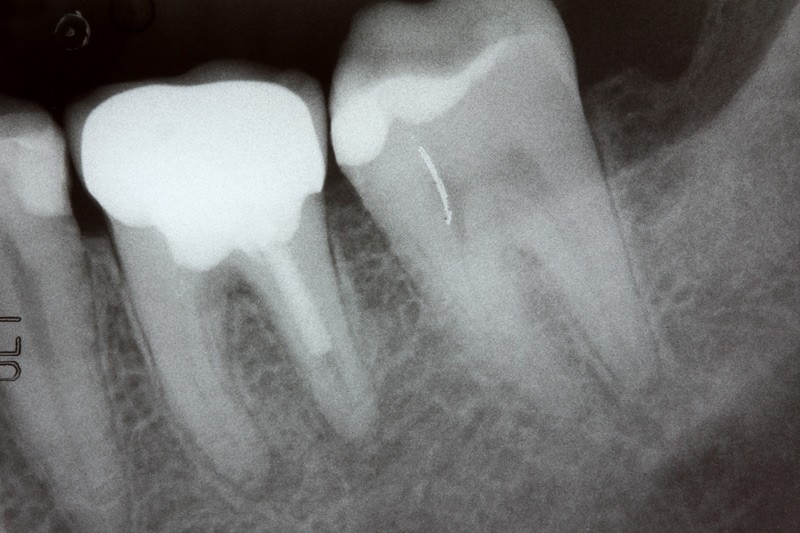 Xray of a failed root canal