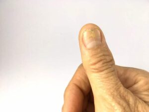 Photo of cracked thumb nail from "Ridges, Bumps, Or White Spots In Your Fingernails? What Your Nails Say About Your Health" at Green Smoothie Girl.