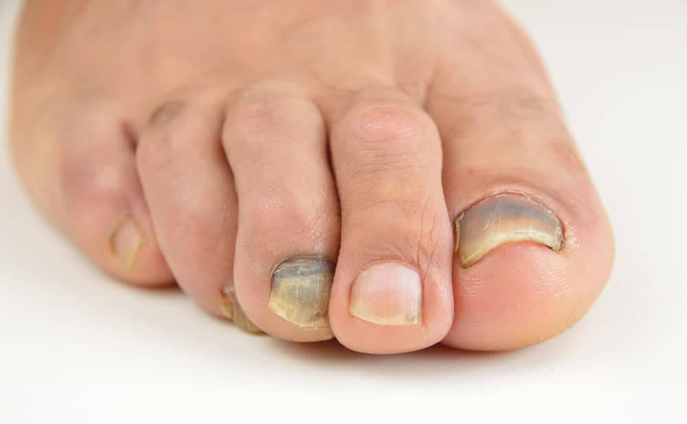 Ridges, Bumps, Or White Spots In Your Fingernails? What Your Nails Say