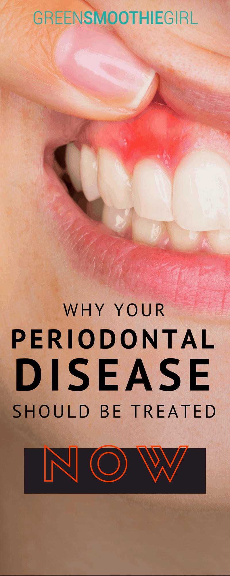 Why Your Periodontal Disease Should Be Treated Now | Green Smoothie Girl