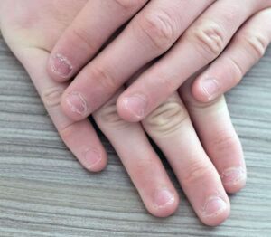 Photo of fingernail burrs from "Ridges, Bumps, Or White Spots In Your Fingernails? What Your Nails Say About Your Health" at Green Smoothie Girl.