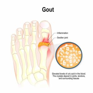 Graphic of gout from "Health Benefits of Alkaline Water" at Green Smoothie Girl.