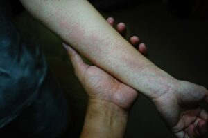 Photo of person with hives on their arm from "Why You Might Have Iodine Deficiency, And What To Do Next" at Green Smoothie Girl.