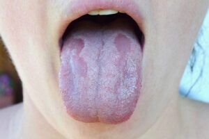 Photo of oral candidiasis from "Surprising (And Proven) Uses and Benefits of Castor Oil" at Green Smoothie Girl.