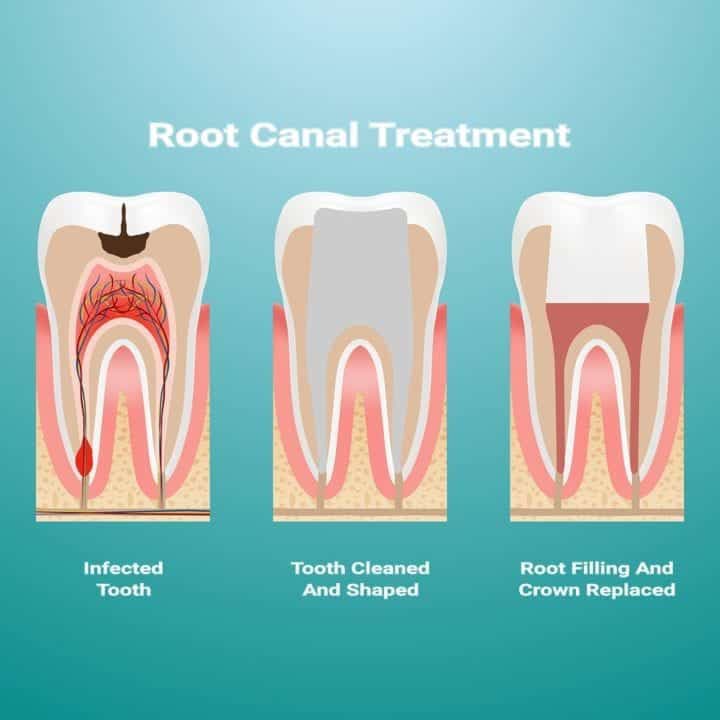 Why Root Canals Fail, and What to Do About It - GreenSmoothieGirl