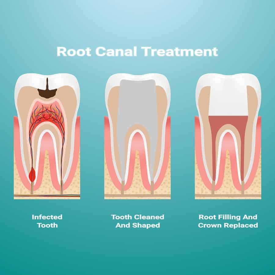 Why Root Canals Fail, and What to Do About It GreenSmoothieGirl