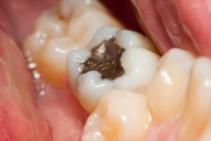 Photo of amalgam filling in tooth from "Are Amalgam Fillings Safe? A Biological Dentist Weighs In" by Green Smoothie Girl
