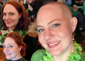 Women balding and losing hair